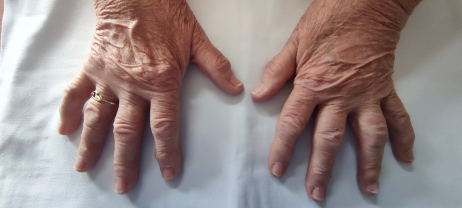 a kéz deformált artrózisa és kezelése)