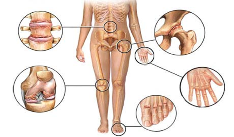 Térdízületi artrózis: első tünetek, kezelés, megelőzés és étrend